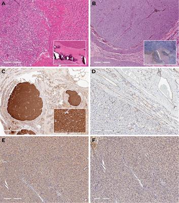 Case report: Sagliker syndrome in the patient with recurrent tertiary hyperparathyroidism due to intrathyroidal parathyroid carcinoma